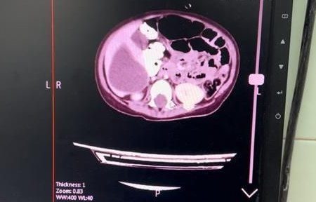 عمل جراحی پیچیده سه عضو مبتلا به کیست هیداتید در کودک۳ ساله در بیمارستان علی بن ابی طالب (ع) زاهدان